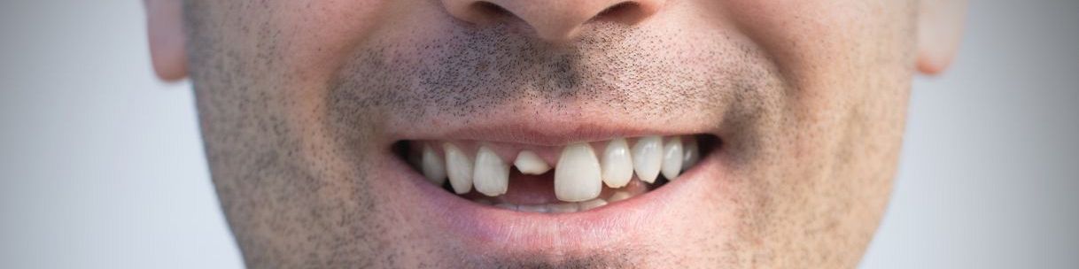 Chipped Tooth Repair in Kelowna: What You Need to Know